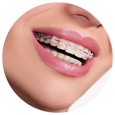 Orthodontic Treatment | DM Arevalo Dental Clinic