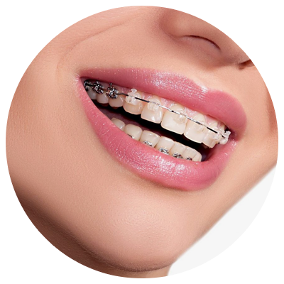 Orthodontic Treatment | DM Arevalo Dental Clinic Orthodontic Treatment | DM Arevalo Dental Clinic