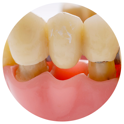 Bridges | DM Arevalo Dental Clinic Bridges | DM Arevalo Dental Clinic