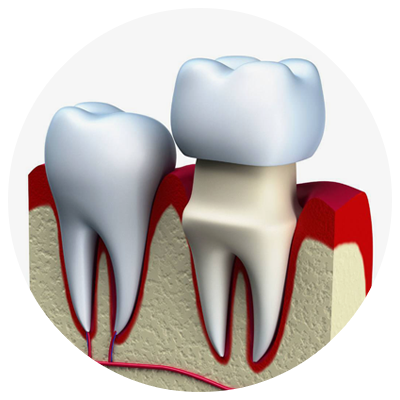 Crowns | DM Arevalo Dental Clinic