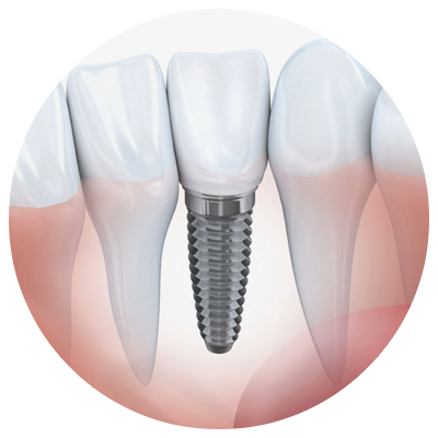 Implants | Arevalo Dental Clinic