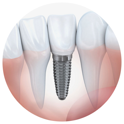 Implants | Arevalo Dental Clinic Implants | Arevalo Dental Clinic