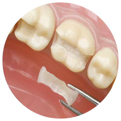Inlay/Onlay | DM Arevalo Dental Clinic