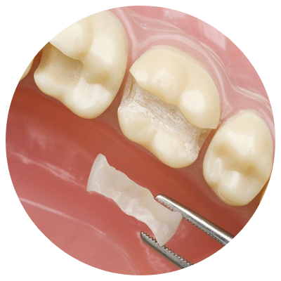 Inlay/Onlay | DM Arevalo Dental Clinic Inlay/Onlay | DM Arevalo Dental Clinic