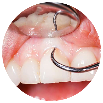 Periodontics | DM Arevalo Dental Clinic