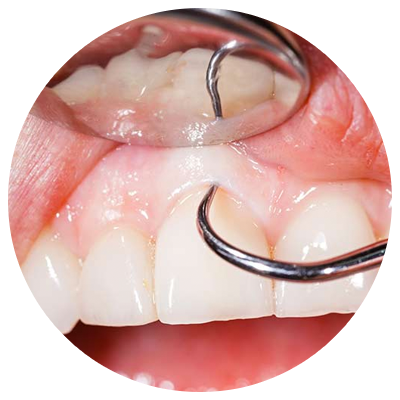 Periodontics | DM Arevalo Dental Clinic Periodontics | DM Arevalo Dental Clinic
