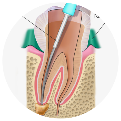 Endodontics (Root Canal) | Arevalo Dental Clinic