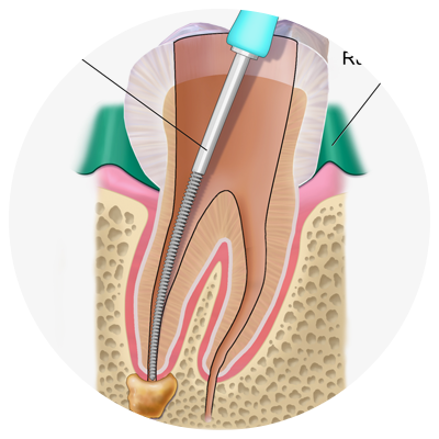 Endodontics (Root Canal) | Arevalo Dental Clinic Endodontics (Root Canal) | Arevalo Dental Clinic