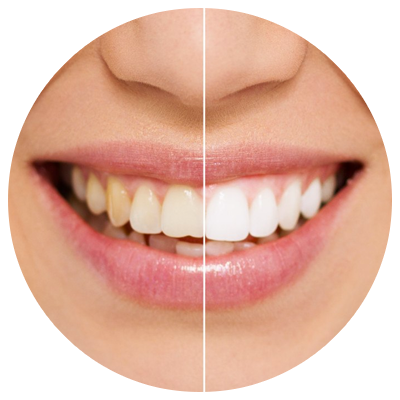 Teeth Whitening | DM Arevalo Dental Clinic
