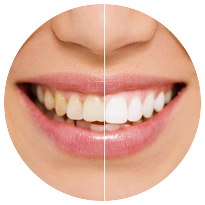 Teeth Whitening | DM Arevalo Dental Clinic Teeth Whitening | DM Arevalo Dental Clinic