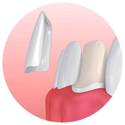 Veneers | DM Arevalo Dental Clinic Veneers | DM Arevalo Dental Clinic